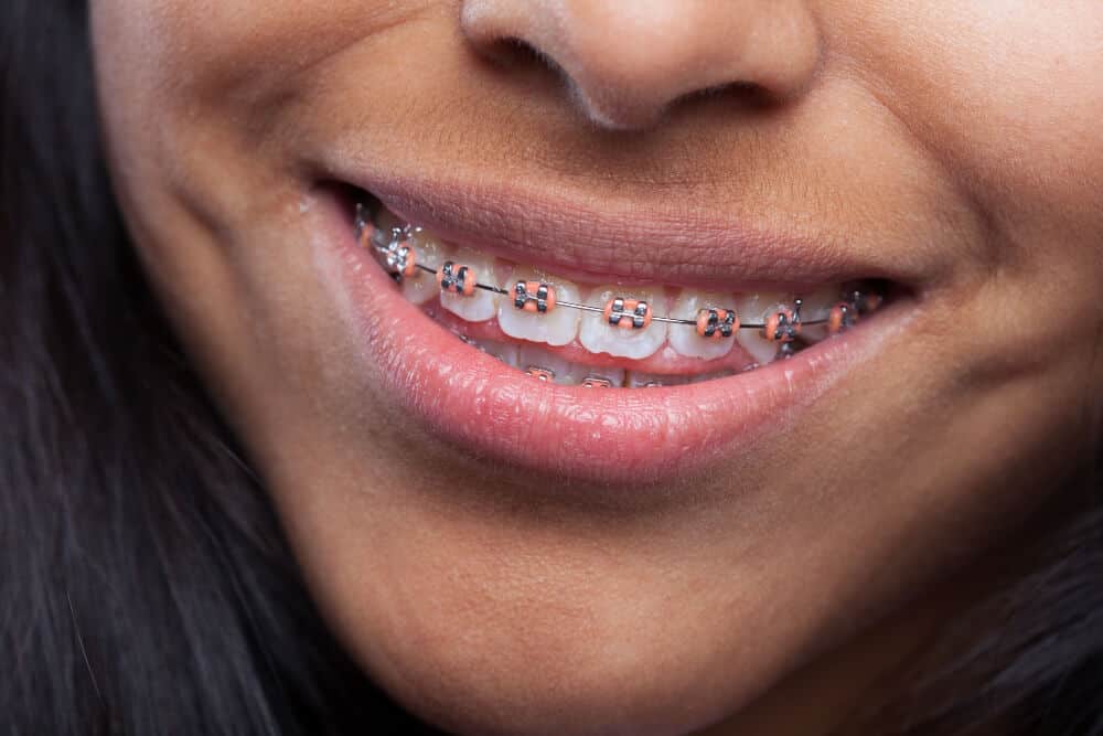 Close-up of braces in North Sydney orthodontic treatment