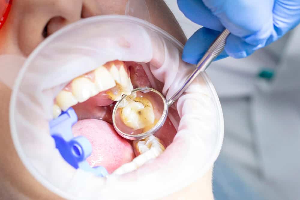 Dentist carefully places a tooth-coloured dental filling in North Sydney
