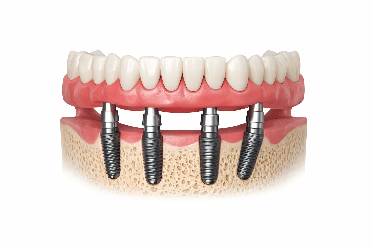 Diagram showing four dental implants supporting a full arch of teeth in North Sydney