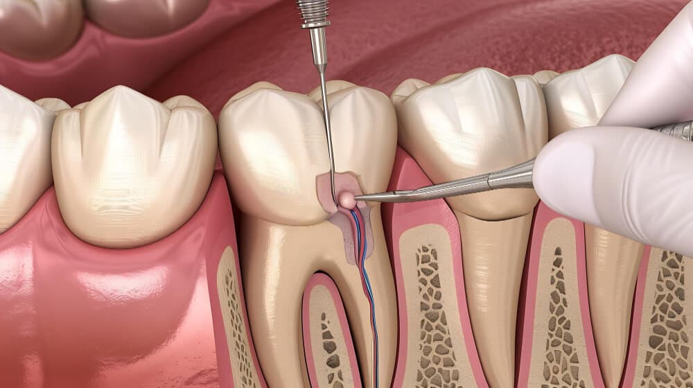Illustration showing the root canal treatment procedure, including cleaning and filling the tooth’s inner pulp in North Sydney
